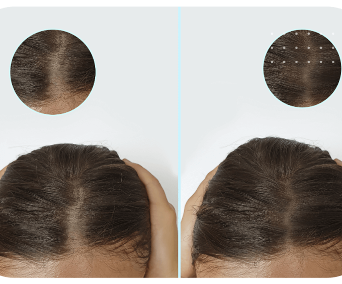 Scalp Micropigmentation