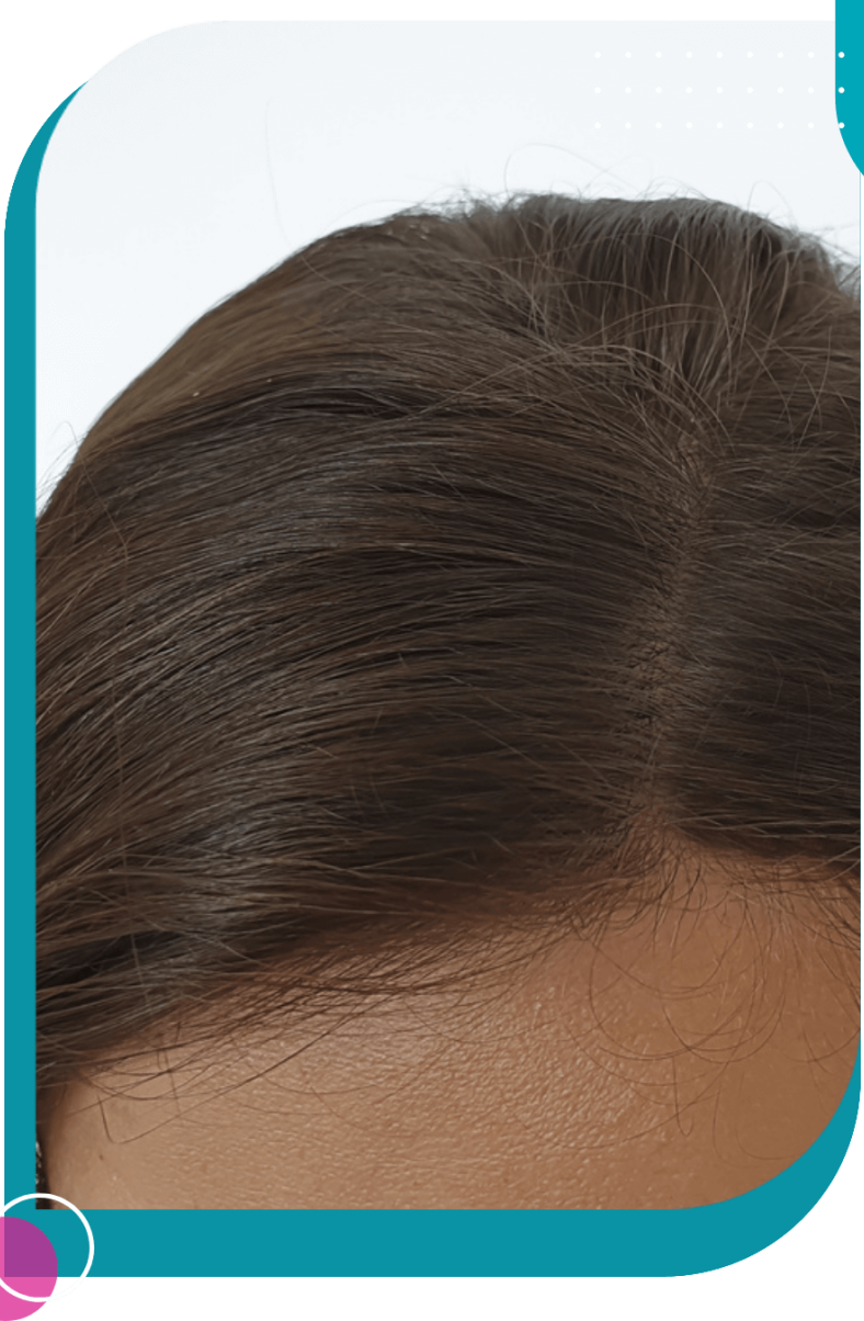 hair micropigmentation