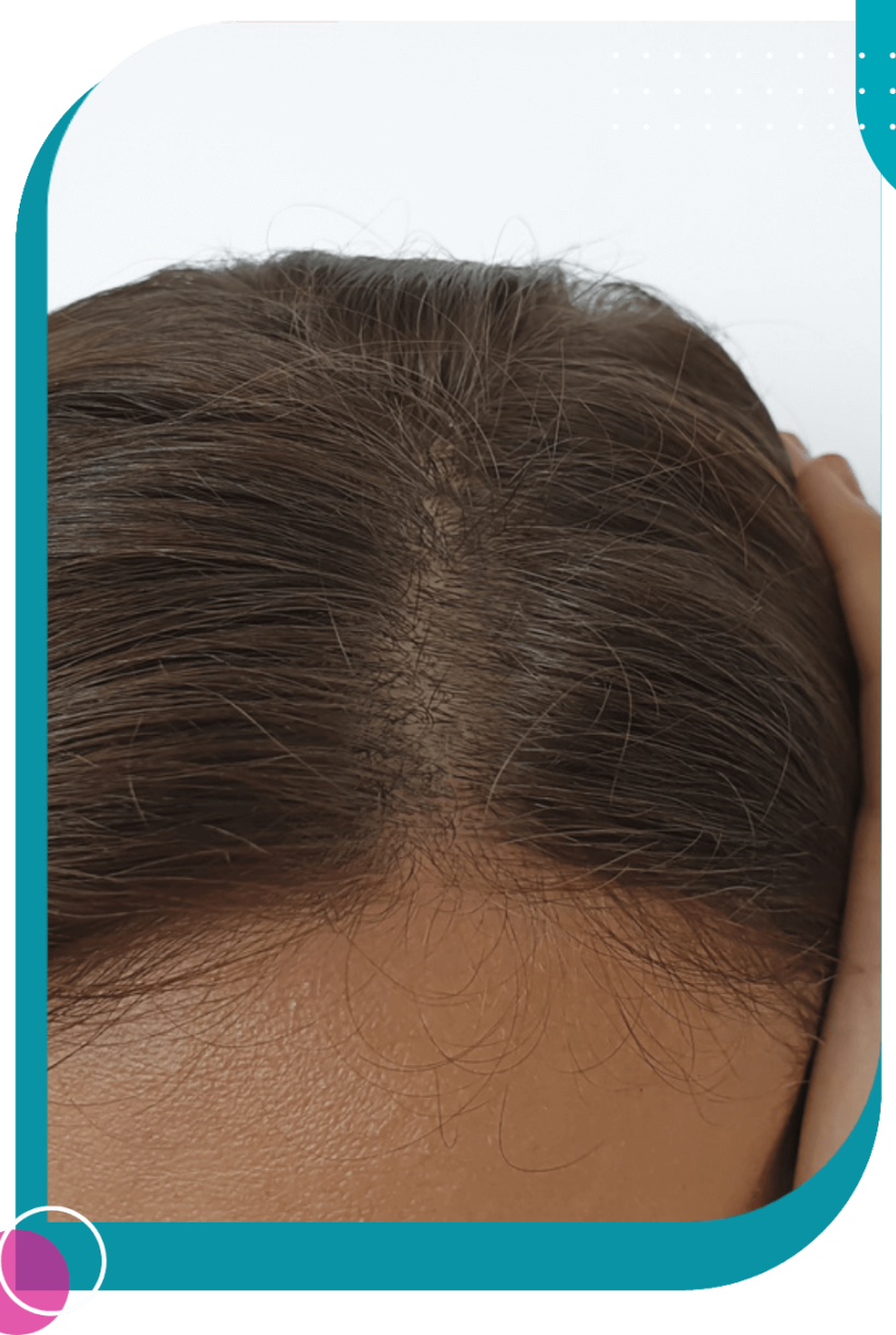 micropigmentation on scalp